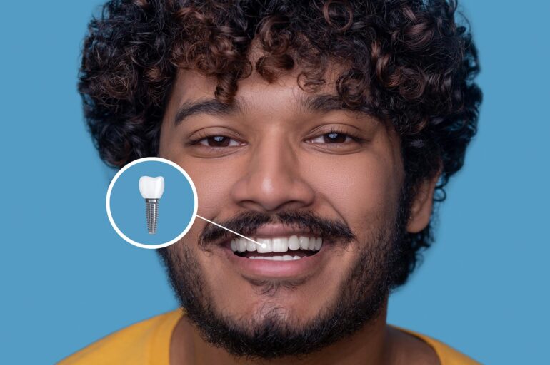 ایمپلنت‌های زیبایی (Cosmetic Dental Implants)